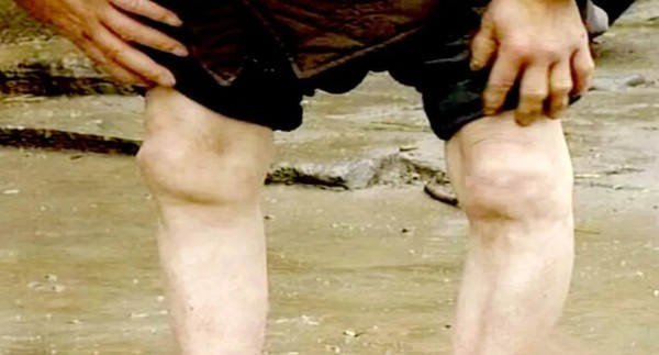 Is fluoridated drinking water safe Is fluoridated drinking water safe