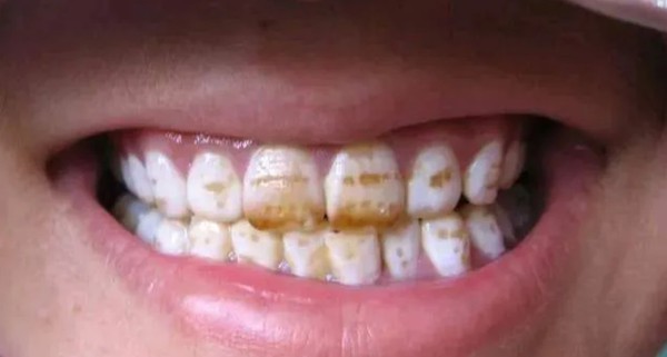 Dental Fluorosis Dental Fluorosis