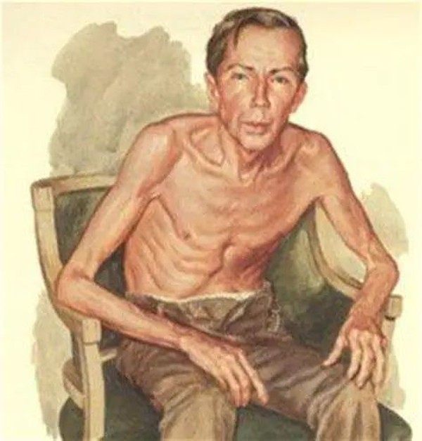 Muscle weakness Muscle weakness